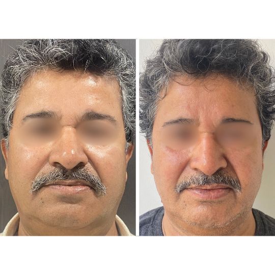 Face Slimming Treatment: Before & After Treatment Result