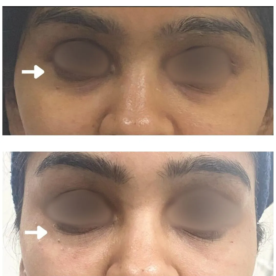 Dark Cicle Reduction treatment
