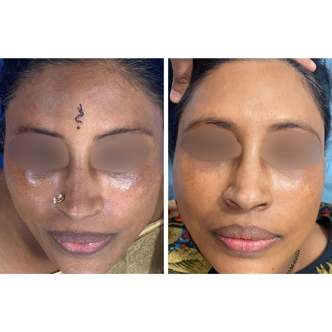 pigmentation treatment: Before & After Treatment Result