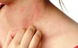 Read more about the article Summer Skin Problems: Prickly Heat and Heat Boils