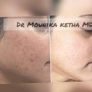 Acne Scar Removal