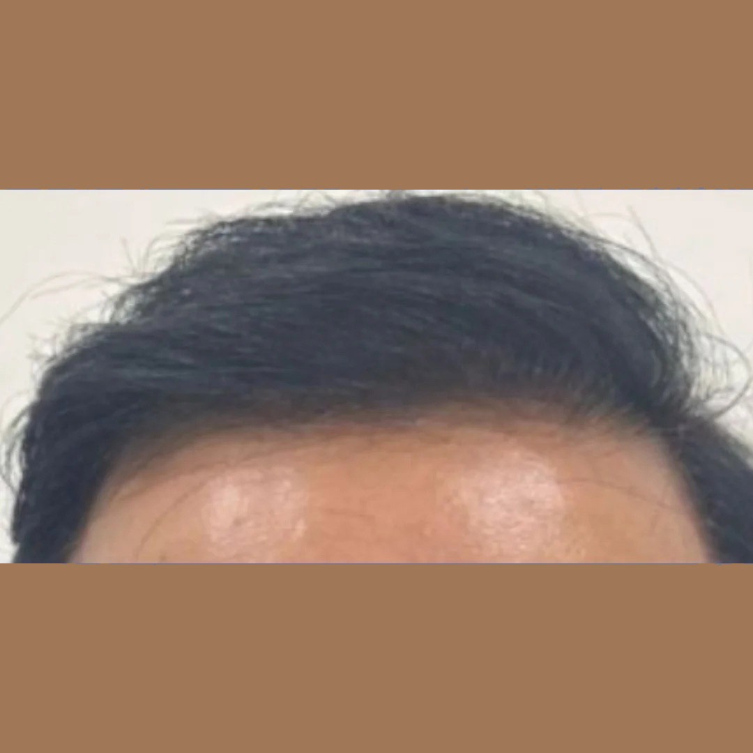 Hair Growth