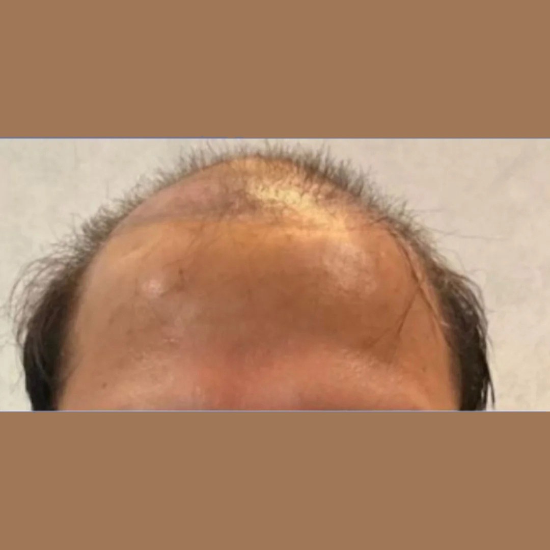 Hair Growth