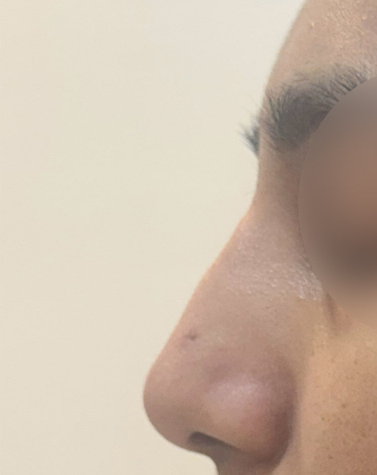Liquid Rhinoplasty Before