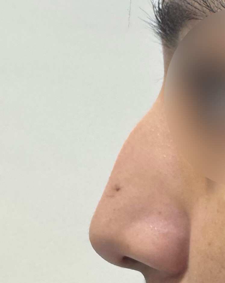 Liquid Rhinoplasty Before