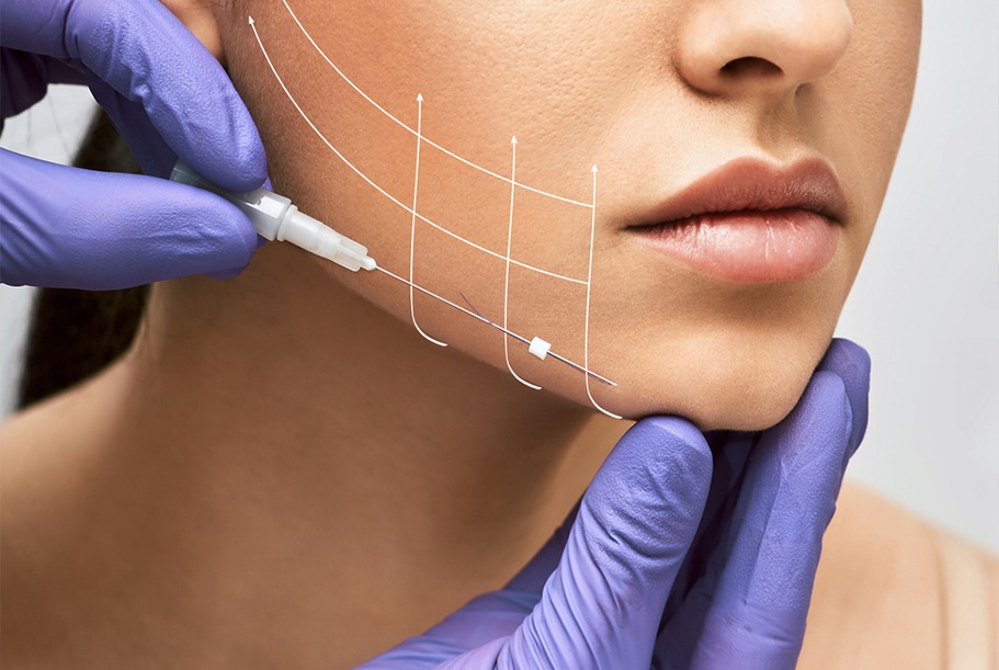 Thread Lift Treatment