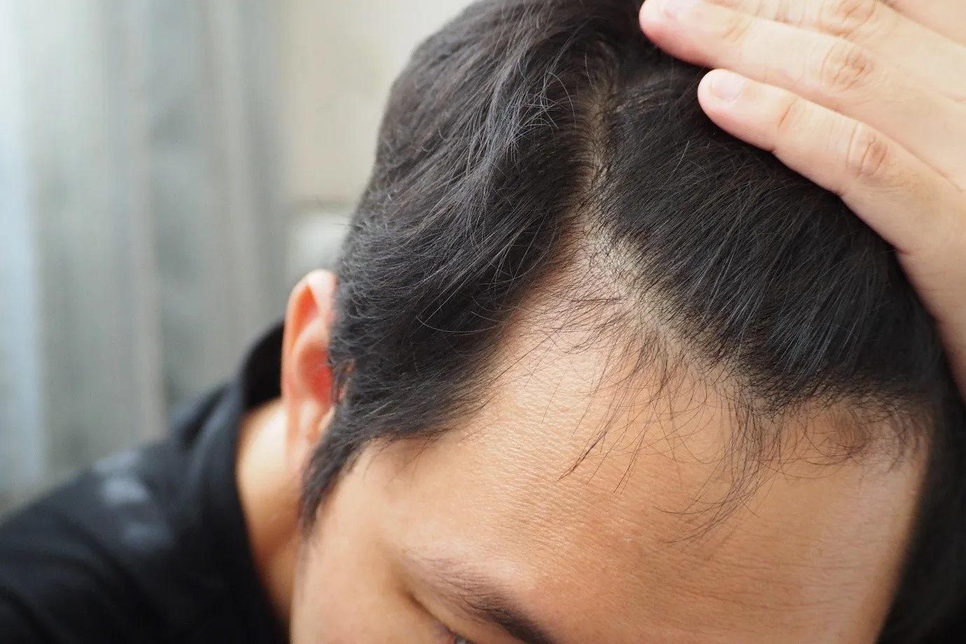 Hair Loss, Dandruff
