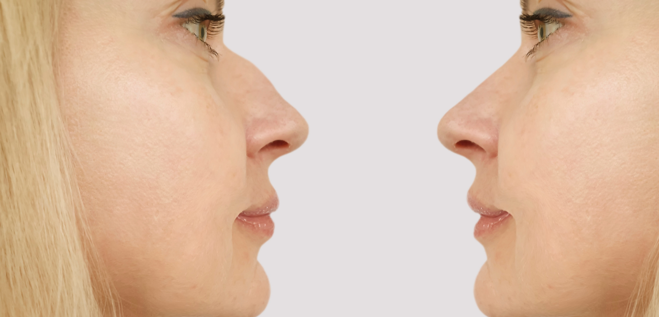 Rhinoplasty (nose job)
