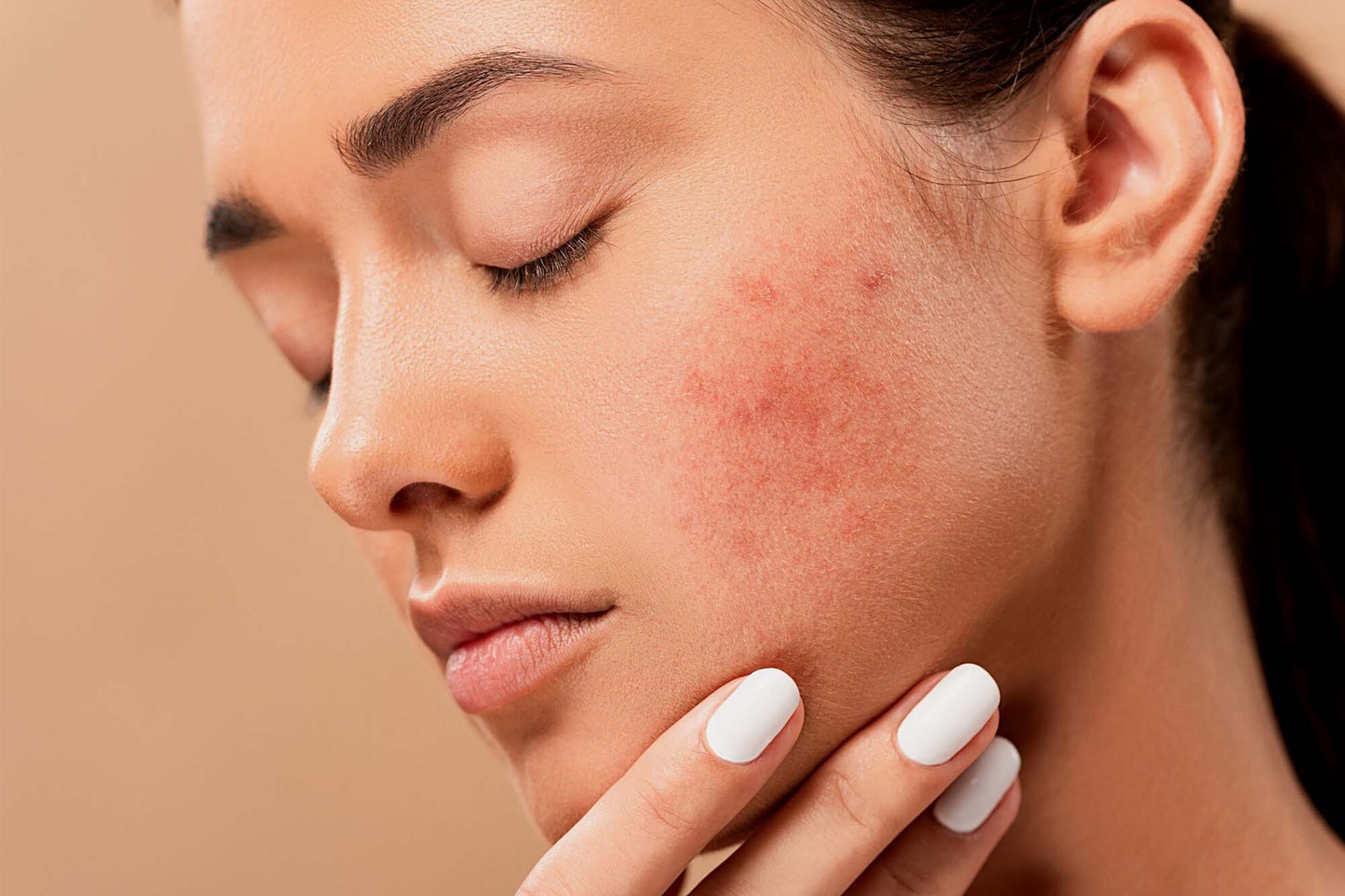 Acne, Pigmentation
