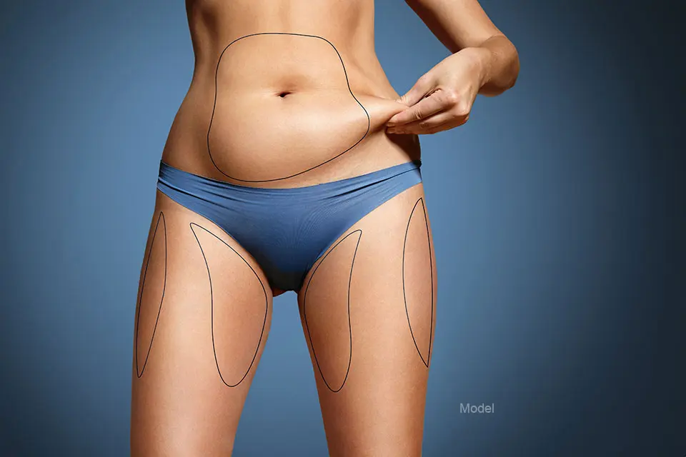 Liposuction, Tummy Tuck, Scar Revision