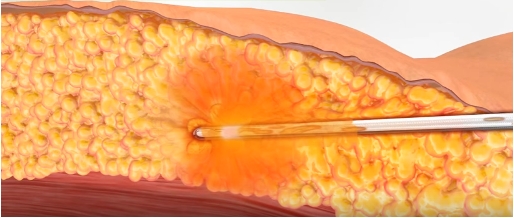 How the Microlift Treatment Works