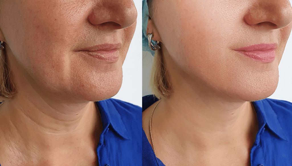 Congenital vs Acquired Turkey Neck