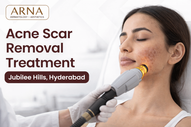 acne scar removal treatment