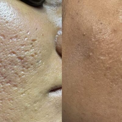 acne scars before after